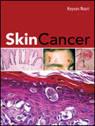 Skin cancer