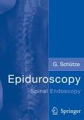 Epiduroscopy: spinal endoscopy