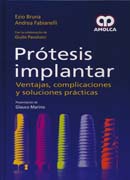 Prótesis Implantar: ventajas, complicaciones y soluciones prácticas